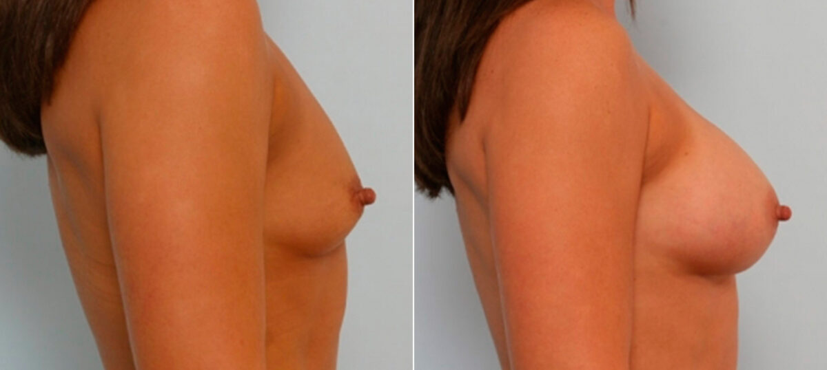 Breast Augmentation before and after photos in Houston, TX, Patient 25824