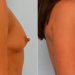 Breast Augmentation before and after photos in Houston, TX, Patient 25824