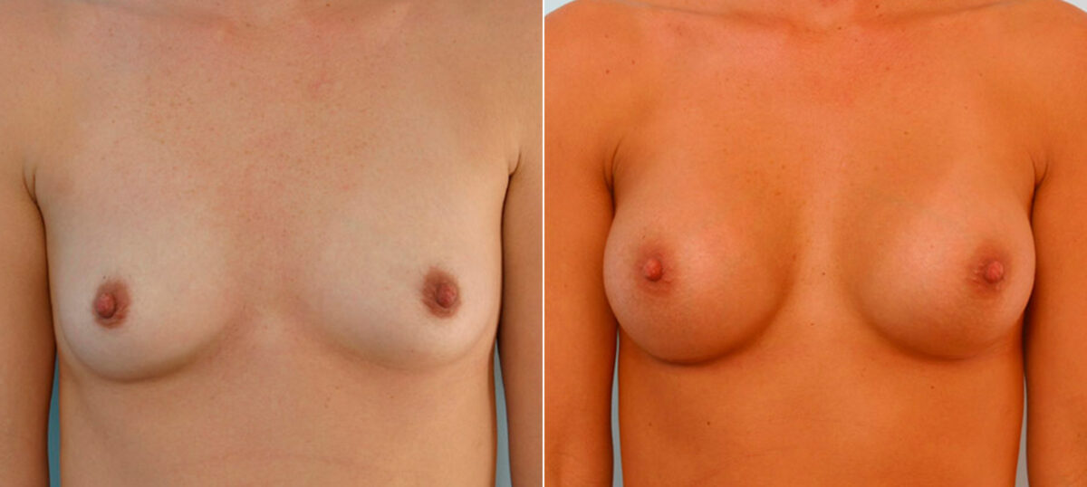 Breast Augmentation before and after photos in Houston, TX, Patient 25831