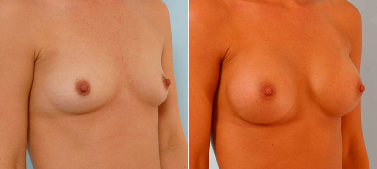 Breast Augmentation before and after photos in Houston, TX, Patient 25831