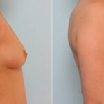 Breast Augmentation before and after photos in Houston, TX, Patient 25838