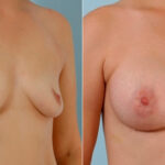 Breast Augmentation before and after photos in Houston, TX, Patient 25845