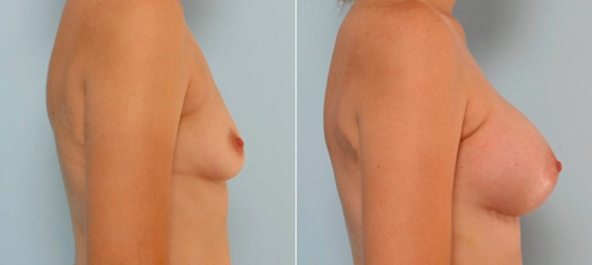 Breast Augmentation before and after photos in Houston, TX, Patient 25845
