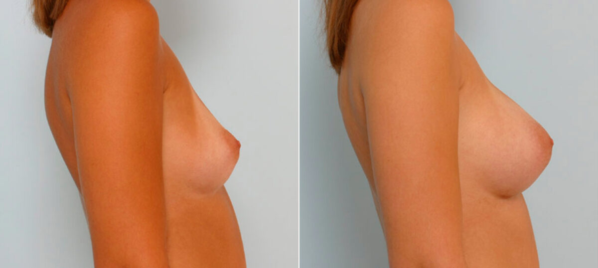 Breast Augmentation before and after photos in Houston, TX, Patient 25852