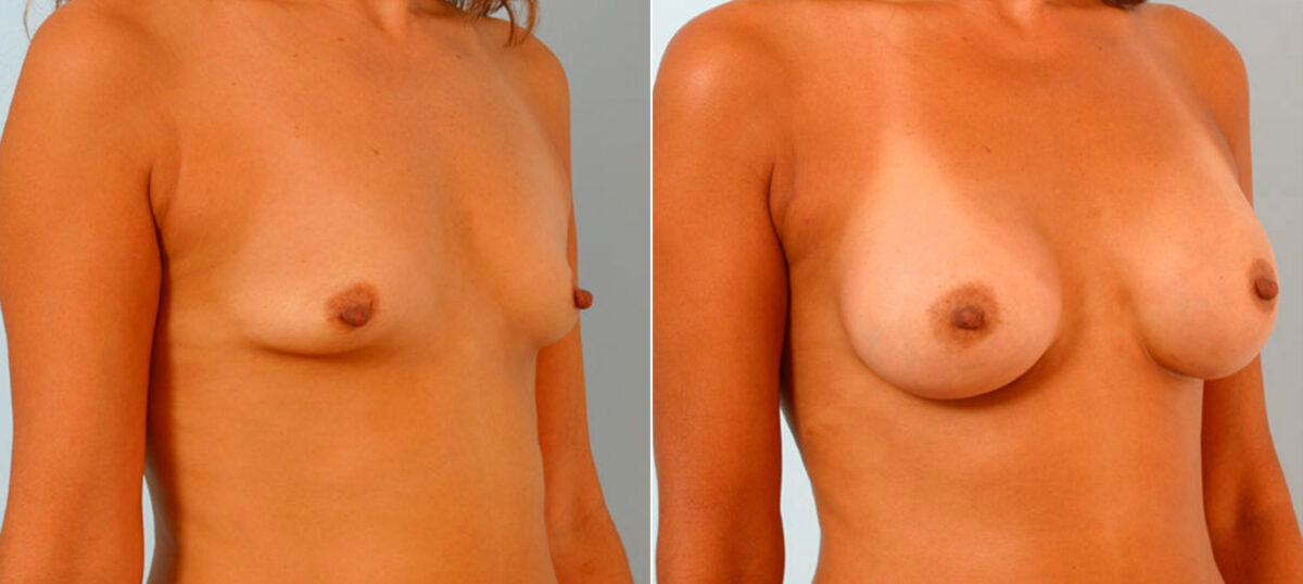 Breast Augmentation before and after photos in Houston, TX, Patient 25859