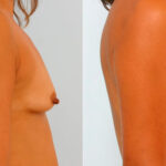 Breast Augmentation before and after photos in Houston, TX, Patient 25859