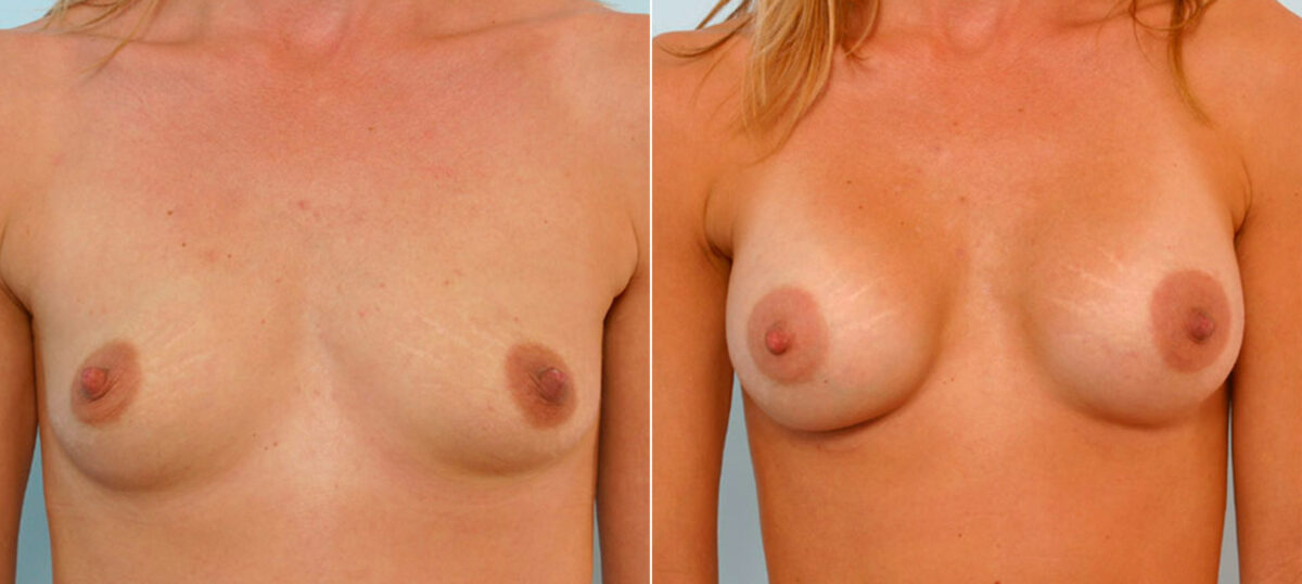 Breast Augmentation before and after photos in Houston, TX, Patient 25866