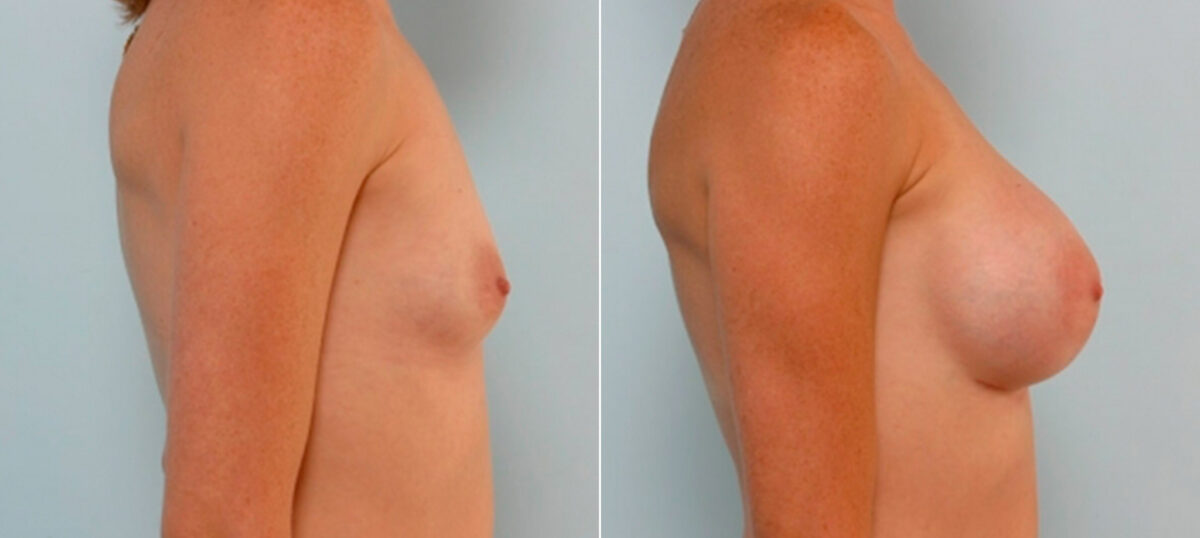 Breast Augmentation before and after photos in Houston, TX, Patient 25873