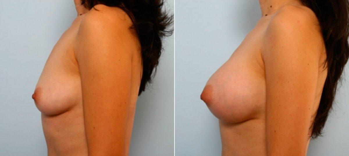 Breast Augmentation before and after photos in Houston, TX, Patient 25880