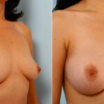 Breast Augmentation before and after photos in Houston, TX, Patient 25880