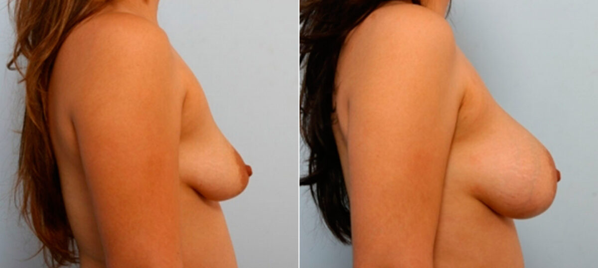 Breast Augmentation before and after photos in Houston, TX, Patient 25891