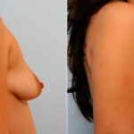 Breast Augmentation before and after photos in Houston, TX, Patient 25891