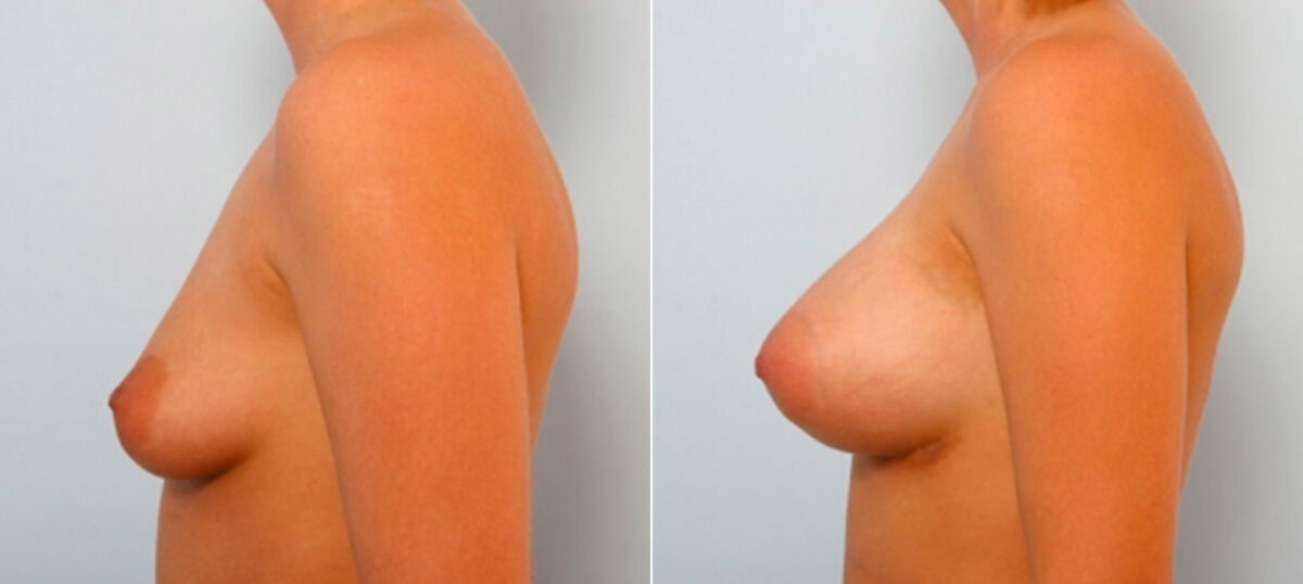 Breast Augmentation before and after photos in Houston, TX, Patient 25902