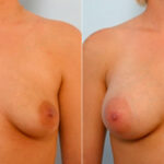 Breast Augmentation before and after photos in Houston, TX, Patient 25902