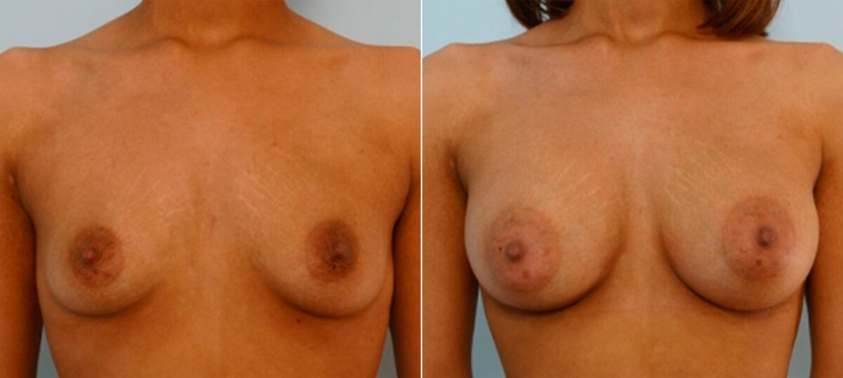 Breast Augmentation before and after photos in Houston, TX, Patient 25909
