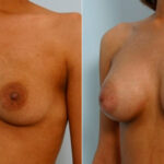 Breast Augmentation before and after photos in Houston, TX, Patient 25909