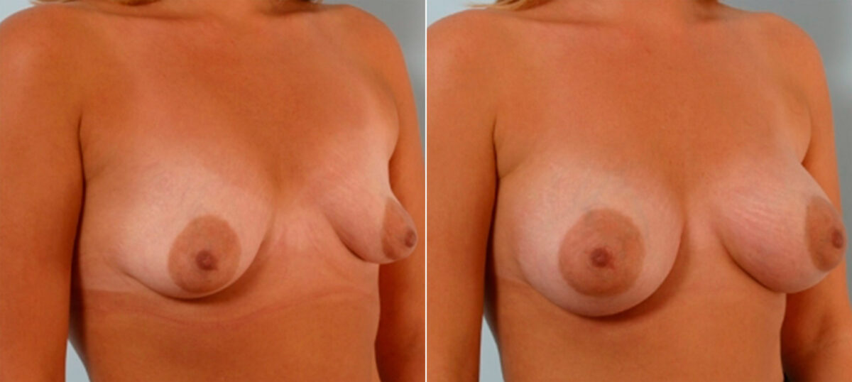 Breast Augmentation before and after photos in Houston, TX, Patient 25920