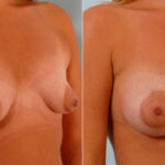 Breast Augmentation before and after photos in Houston, TX, Patient 25920