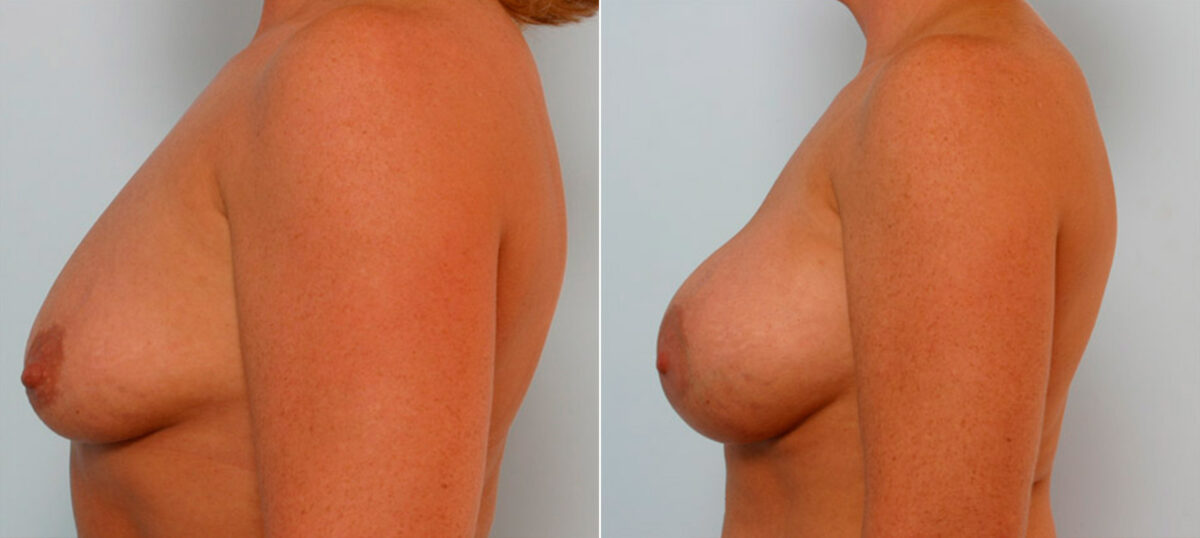Breast Augmentation before and after photos in Houston, TX, Patient 25927