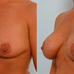 Breast Augmentation before and after photos in Houston, TX, Patient 25927