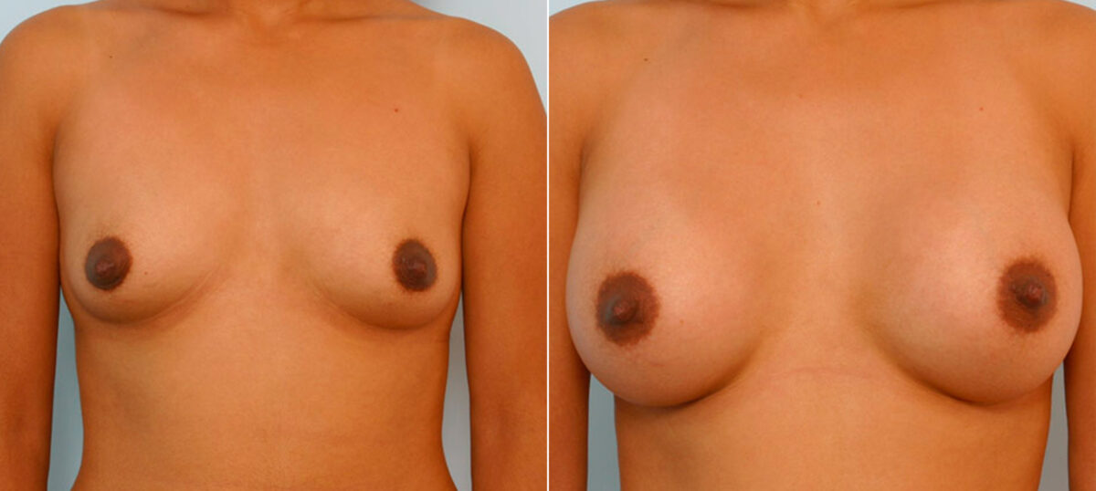 Breast Augmentation before and after photos in Houston, TX, Patient 25938