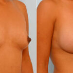 Breast Augmentation before and after photos in Houston, TX, Patient 25938
