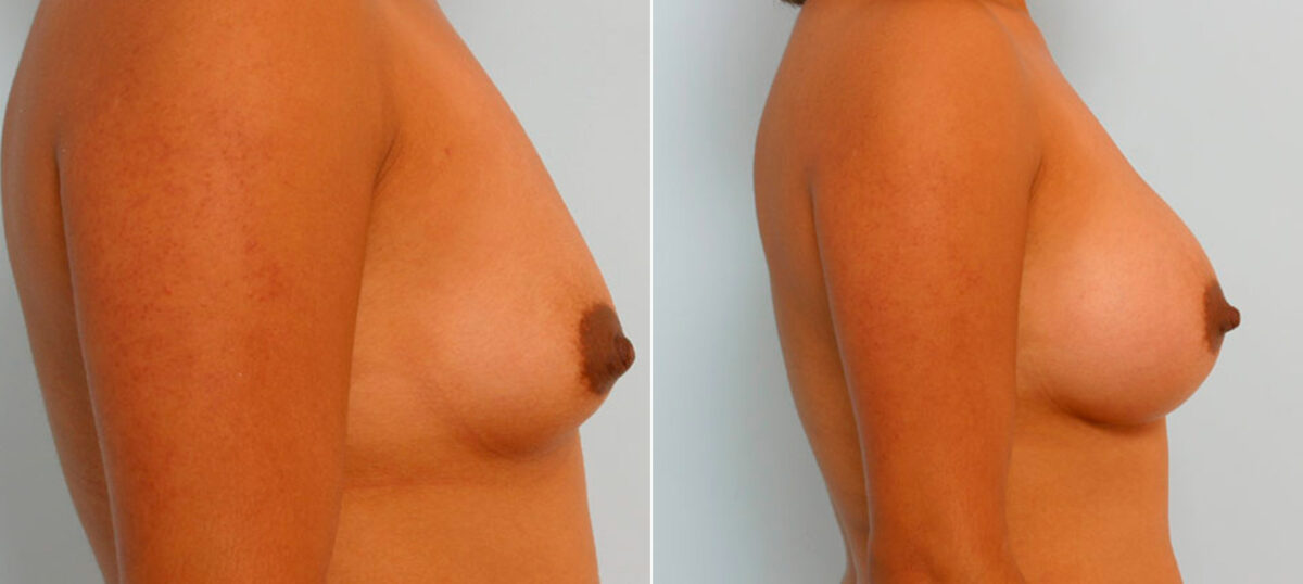 Breast Augmentation before and after photos in Houston, TX, Patient 25938