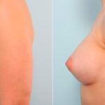 Breast Augmentation before and after photos in Houston, TX, Patient 25945