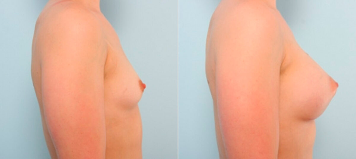 Breast Augmentation before and after photos in Houston, TX, Patient 25945