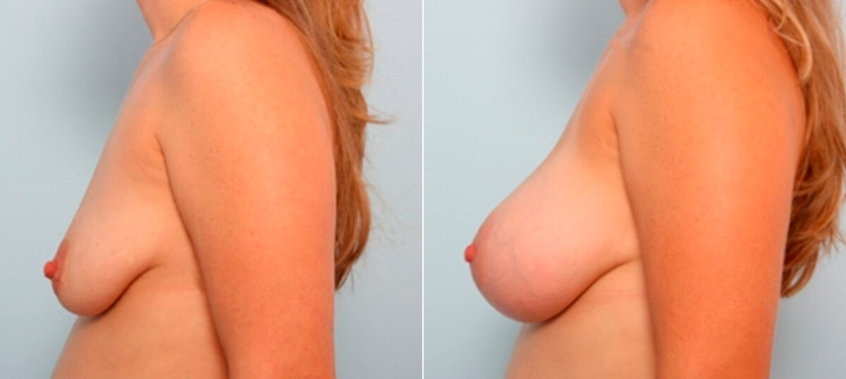 Breast Augmentation before and after photos in Houston, TX, Patient 25956