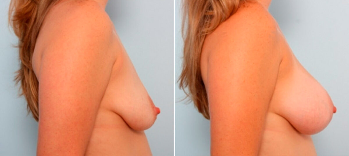Breast Augmentation before and after photos in Houston, TX, Patient 25956