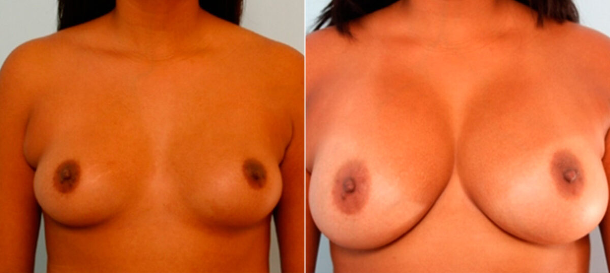 Breast Augmentation before and after photos in Houston, TX, Patient 25967