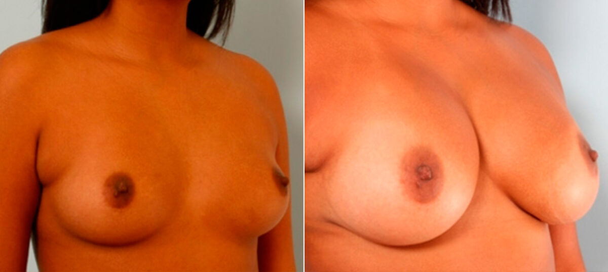 Breast Augmentation before and after photos in Houston, TX, Patient 25967