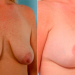 Breast Augmentation before and after photos in Houston, TX, Patient 25978