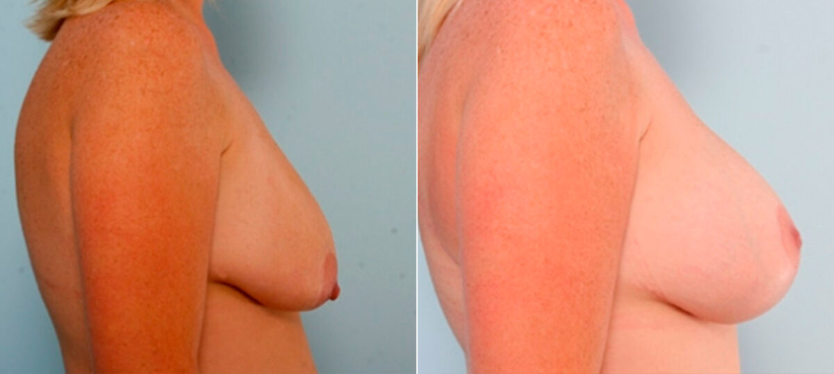 Breast Augmentation before and after photos in Houston, TX, Patient 25978