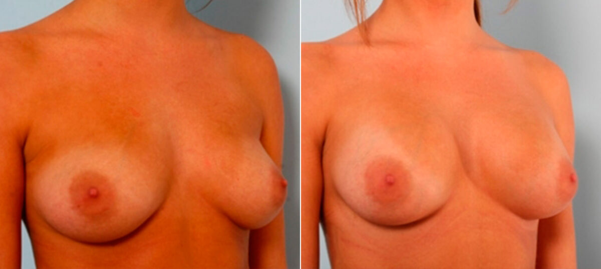 Breast Augmentation before and after photos in Houston, TX, Patient 25989