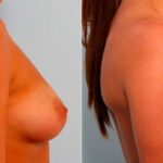 Breast Augmentation before and after photos in Houston, TX, Patient 25989