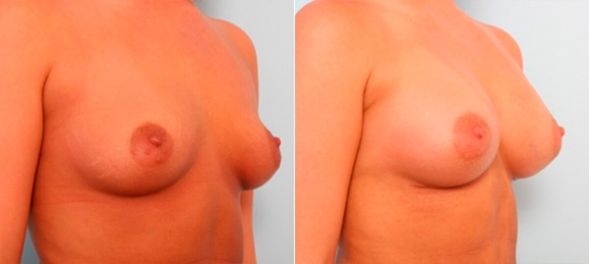 Breast Augmentation before and after photos in Houston, TX, Patient 26000