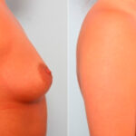 Breast Augmentation before and after photos in Houston, TX, Patient 26000