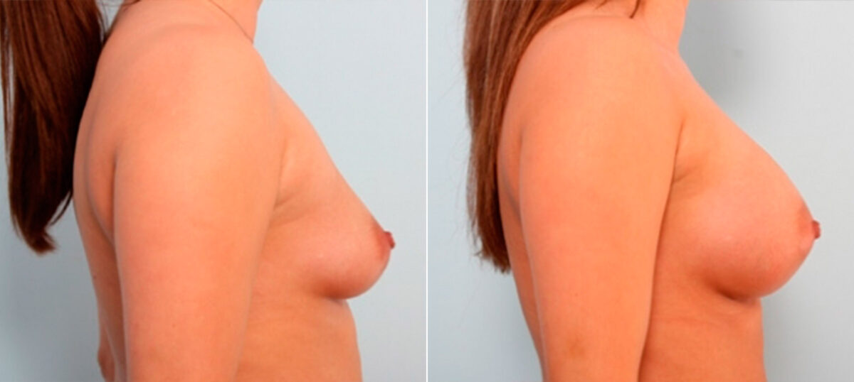 Breast Augmentation before and after photos in Houston, TX, Patient 26011