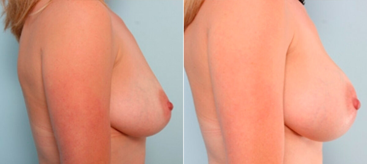 Breast Augmentation before and after photos in Houston, TX, Patient 26022