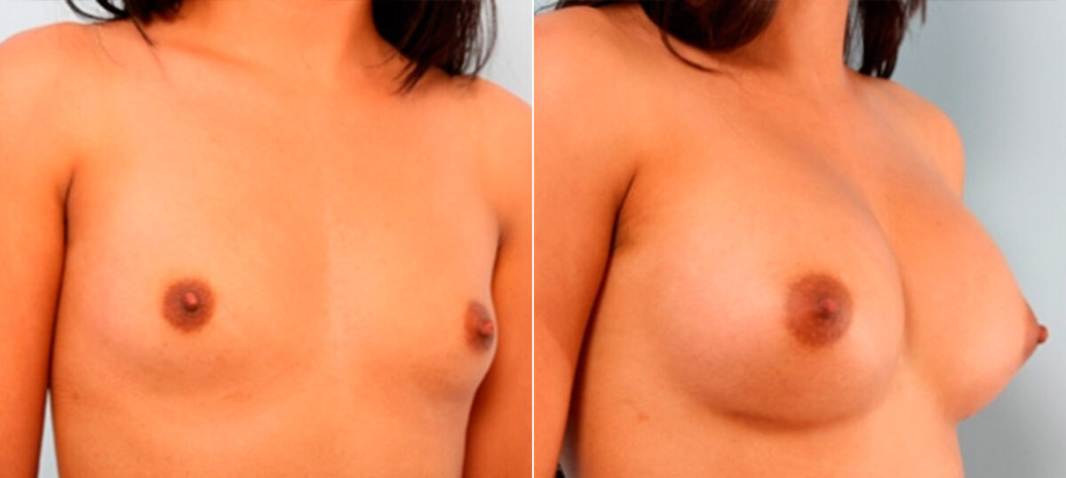 Breast Augmentation before and after photos in Houston, TX, Patient 26033