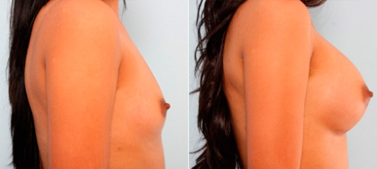 Breast Augmentation before and after photos in Houston, TX, Patient 26033