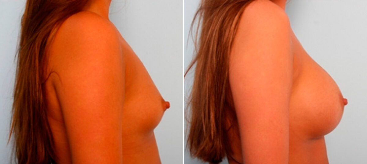 Breast Augmentation before and after photos in Houston, TX, Patient 26044