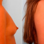 Breast Augmentation before and after photos in Houston, TX, Patient 26044