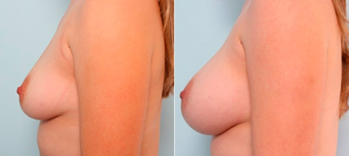 Breast Augmentation before and after photos in Houston, TX, Patient 26055