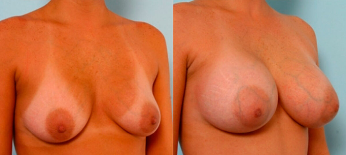 Breast Augmentation before and after photos in Houston, TX, Patient 26066