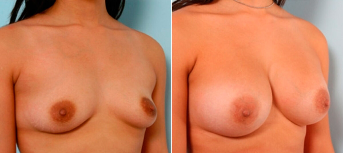 Breast Augmentation before and after photos in Houston, TX, Patient 26077