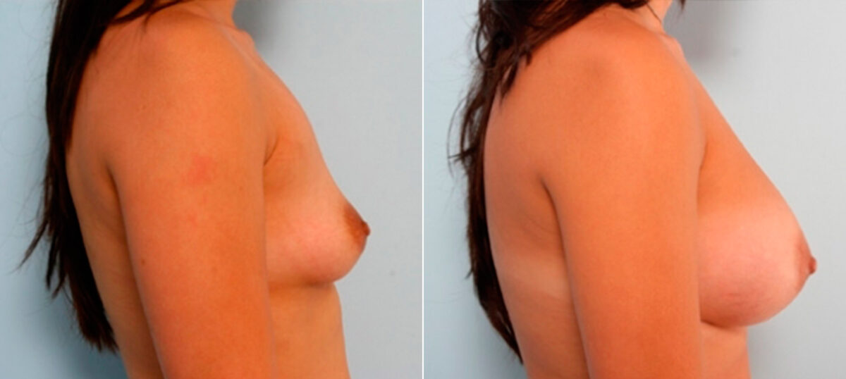 Breast Augmentation before and after photos in Houston, TX, Patient 26077