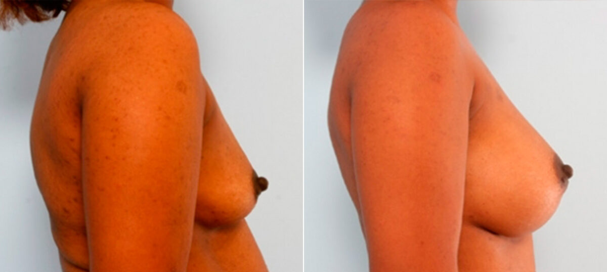 Breast Augmentation before and after photos in Houston, TX, Patient 26088
